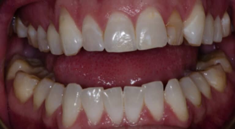 Before Image: Invisalign and Crown - front
