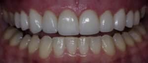 After Image: Veneers
