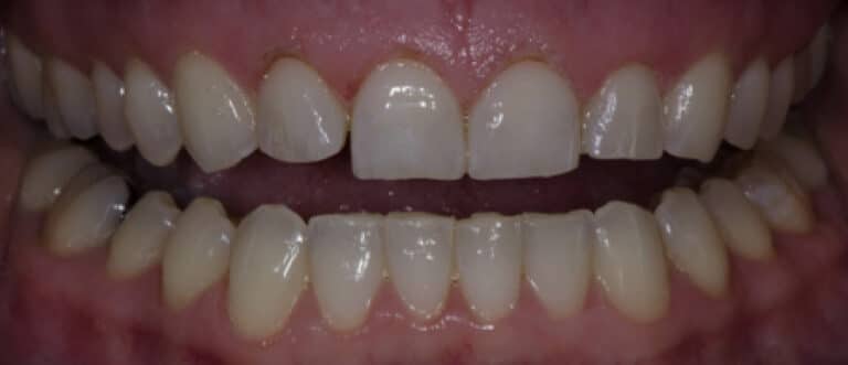 Before Image: Veneers - front