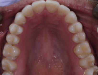 After Image: Invisalign - front