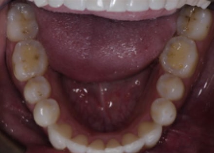 After Image: Invisalign - front
