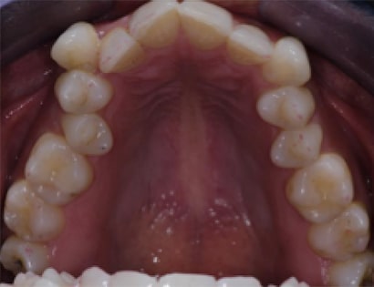 Before Image: Invisalign - front