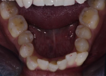 Before Image: Invisalign - front