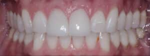 After Image: Invisalign and Crowns