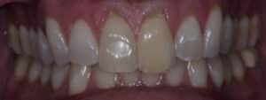 Before Image: Invisalign and Crowns