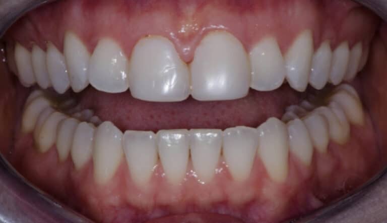 Before Image: Veneers - front