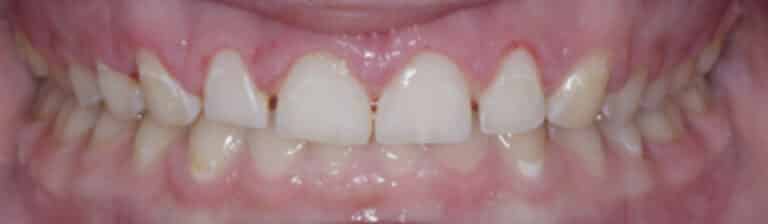 Before Image: Veneers - front