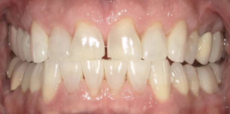 Before Image: Crowns and Veneers - front