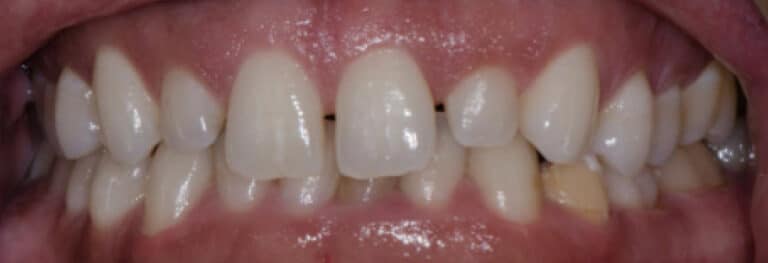 Before Image: Prepless Veneers - front
